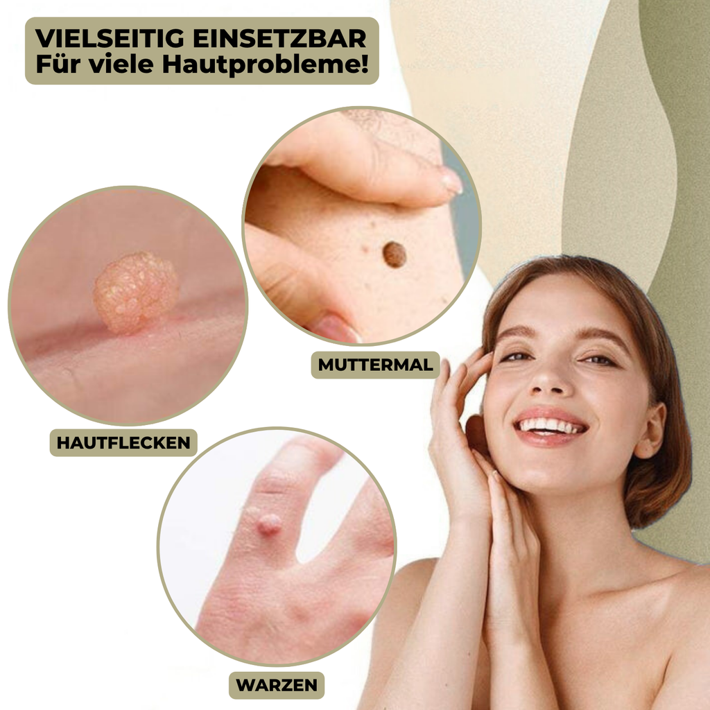 Kalsten | DermaLinx Removedor de Verrugas | Eliminación Sin Dolor de Verrugas y Lunares | Para Uso en Casa | Sin Cirugía