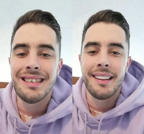 Carillas On Smile (incluye maxilar superior e inferior)
