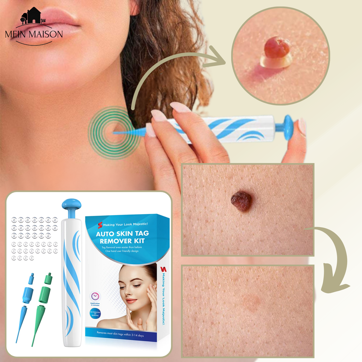 Kalsten | DermaLinx Removedor de Verrugas | Eliminación Sin Dolor de Verrugas y Lunares | Para Uso en Casa | Sin Cirugía