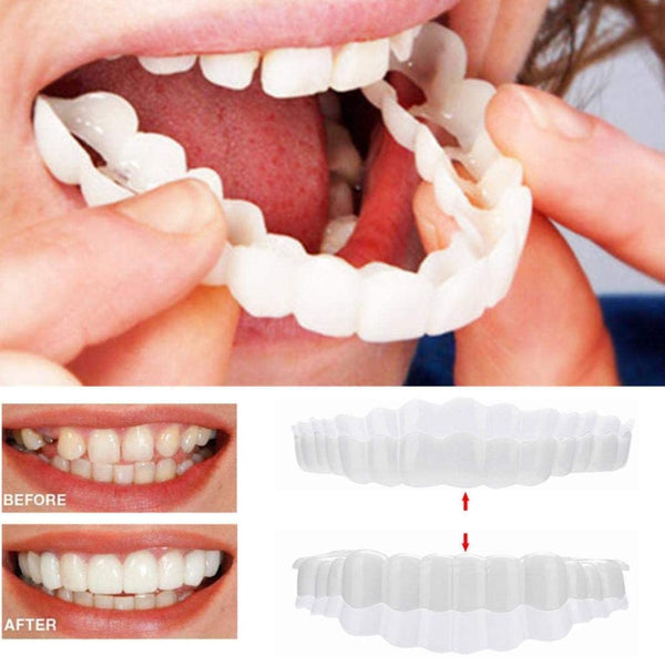 Carillas On Smile (incluye maxilar superior e inferior)