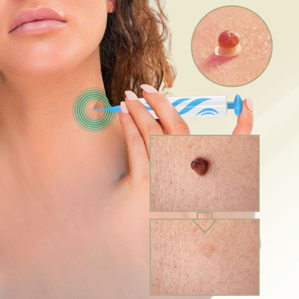 Kalsten | DermaLinx Removedor de Verrugas | Eliminación Sin Dolor de Verrugas y Lunares | Para Uso en Casa | Sin Cirugía