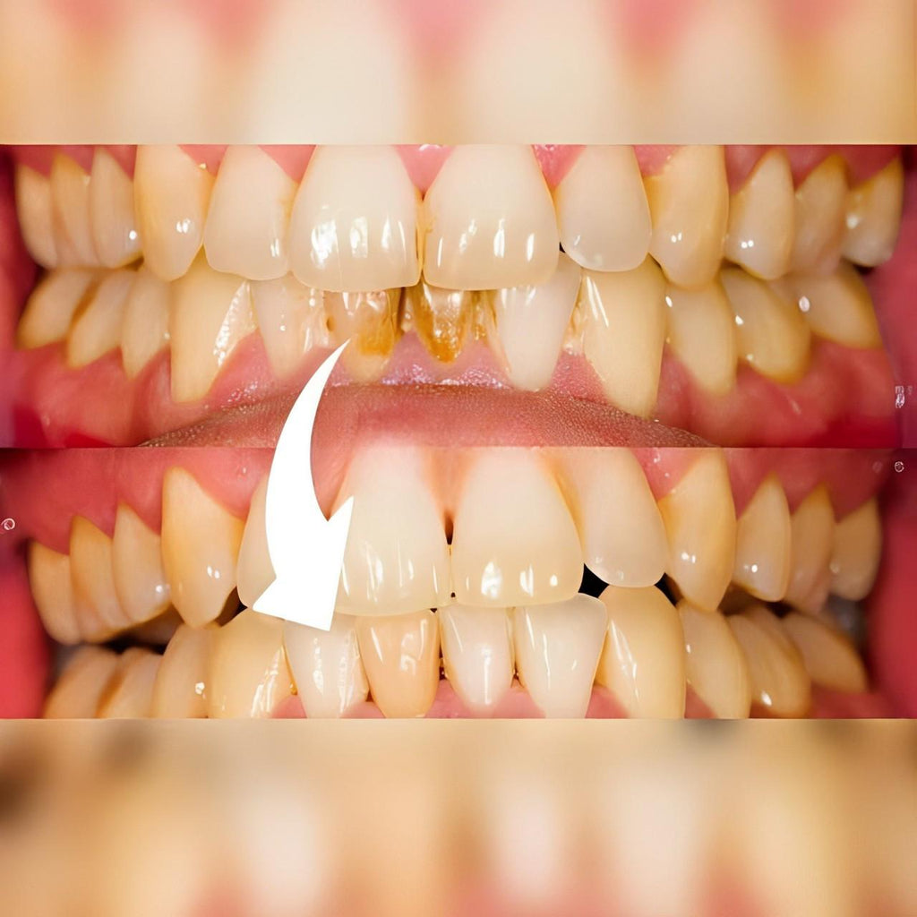 Escalador Dental Profesional