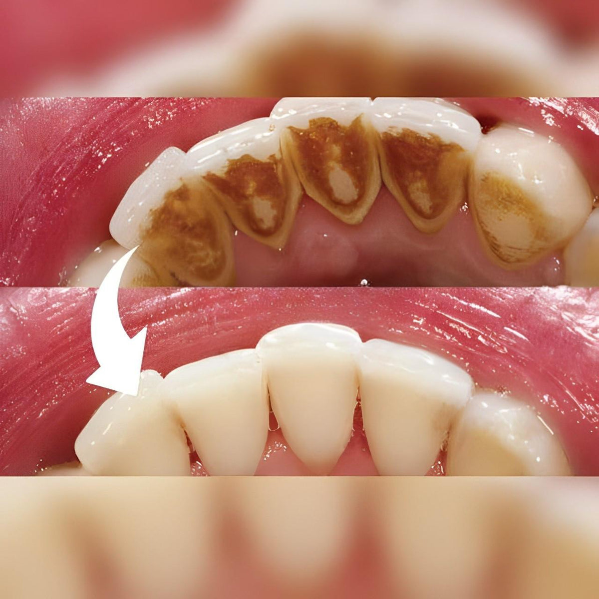Escalador Dental Profesional