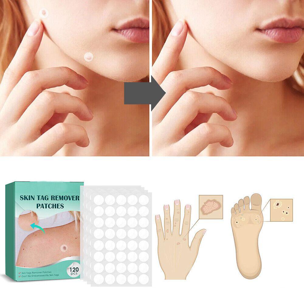 SkinClear - Parche para la eliminación de manchas y verrugas 120 Piezas Parches para la Piel