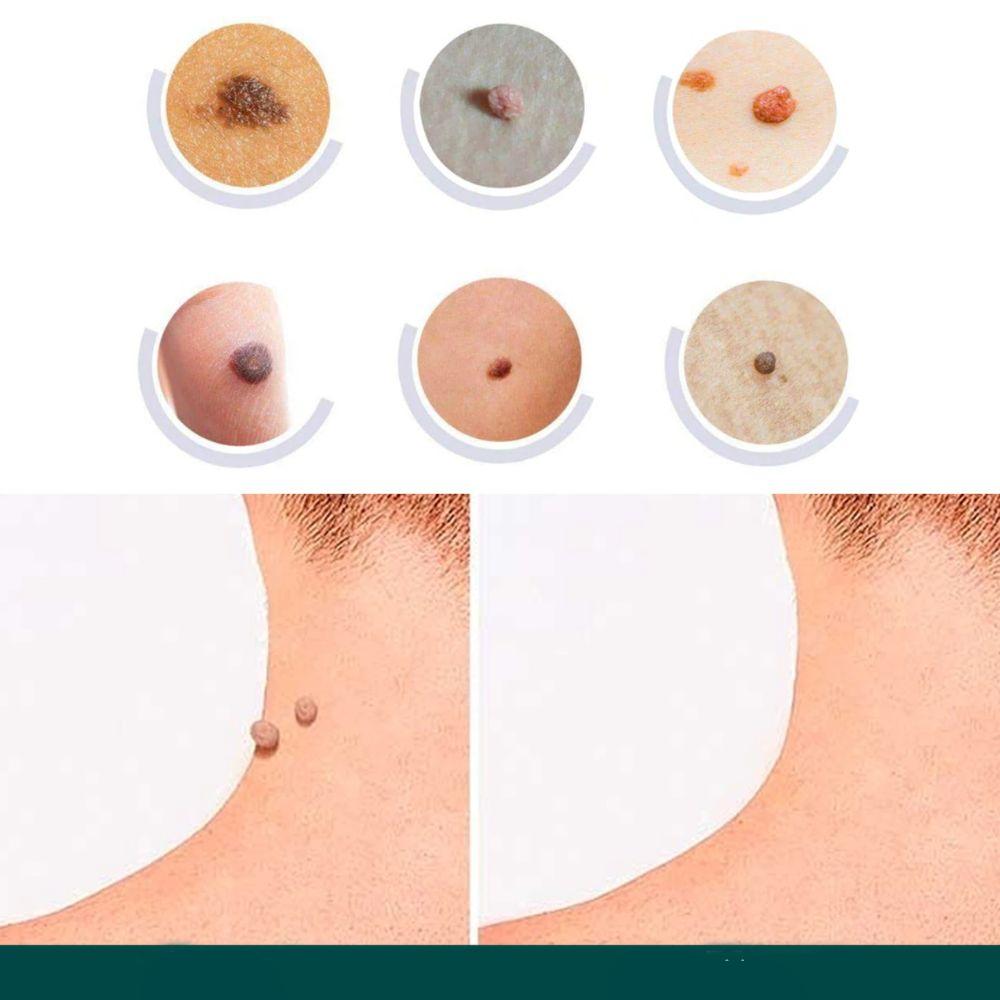 SkinClear Eliminador de Verrugas | Parche para la eliminación de etiquetas de piel y verrugas | Tecnología de hidrocoloides | Sin dolor y discreto | Para todos los tipos de piel | 120 piezas