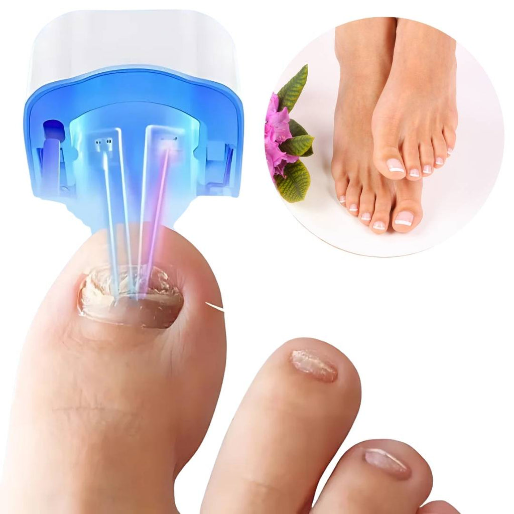 Tratamiento láser eficaz y sin dolor para hongos en las uñas