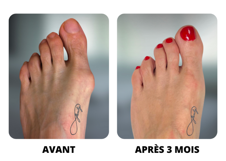 Corrector Universal para Hallux Valgus