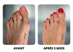 Corrector Universal para Hallux Valgus